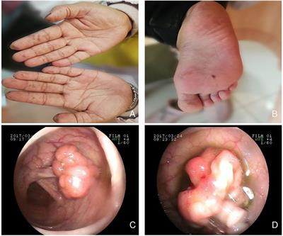 Peutz-Jeghers syndrome with gastric-type mucinous endocervical adenocarcinoma and sex-cord tumor with annular tubules: A case report